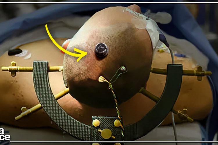 Neuralink Reveals First Human Patient!